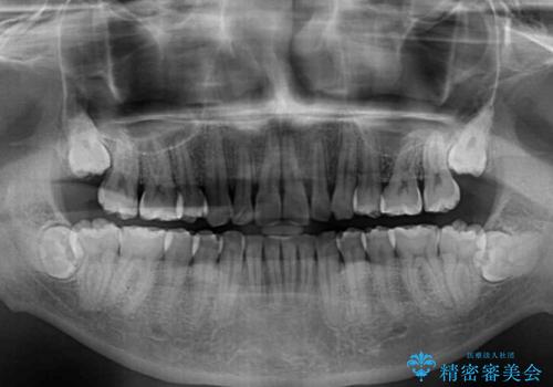 強い咬み込みですり減った前歯 デコボコを抜歯矯正で整えるの治療後