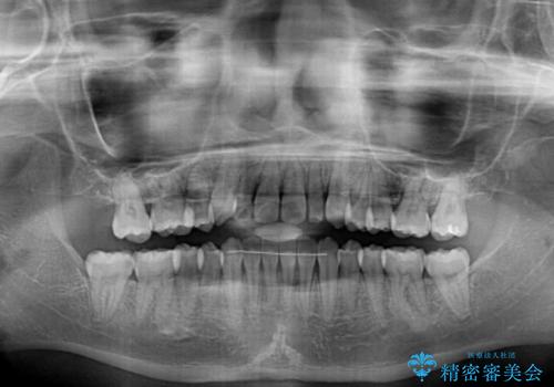 八重歯の抜歯矯正 補助装置を用いたインビザライン矯正の治療後