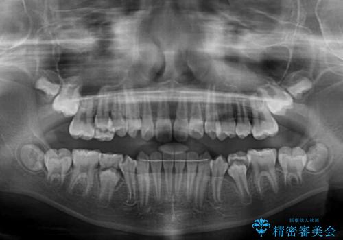 過剰歯を抜歯して前歯を排列　インビザライン・ファーストによる小学生のⅠ期治療の治療後