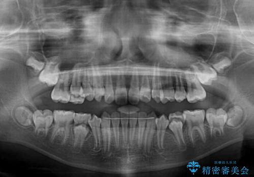 過剰歯を抜歯して前歯を排列 インビザライン・ファーストによる小学生のⅠ期治療の治療後