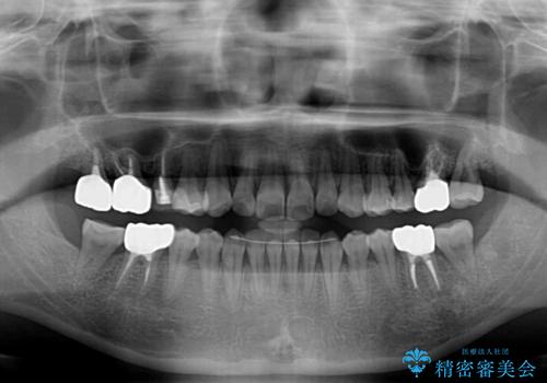 気になる前歯をインビザライン・ライトで 矯正治療後には銀歯をセラミックにの治療後