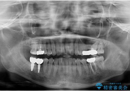虫歯を放置 しっかり治療したい。 抜歯してインプラント治療の治療後