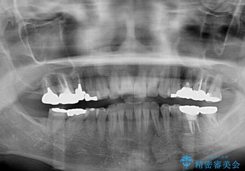 痛む奥歯と矯正の後戻り インビザライン・ライトとセラミック治療の治療後