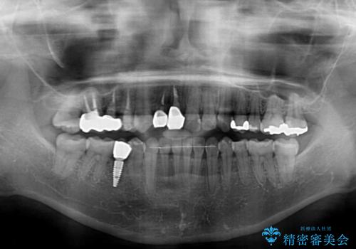 前歯のクロスバイトと治療が必要なむし歯 矯正とセラミックの総合歯科治療の治療後