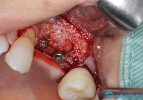 骨の造成を伴うインプラント治療の治療中