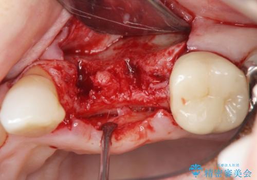 骨の造成を伴うインプラント治療の治療前