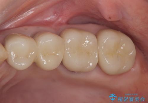 骨の造成を伴うインプラント治療の治療後