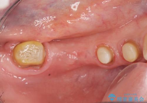 臼歯部メタルフリー再補綴の治療中