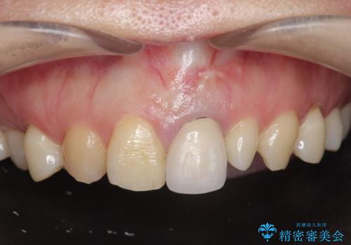 [ 前歯セラミック治療 ]白く不自然な前歯をきれいにしたいの症例 治療前