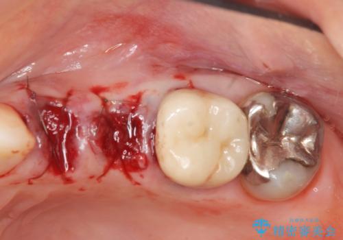 骨の造成を伴うインプラント治療の治療前