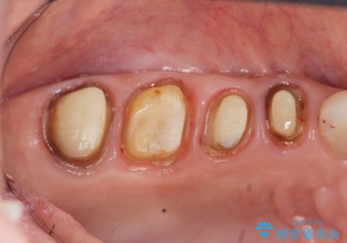 臼歯部メタルフリー再補綴の治療中