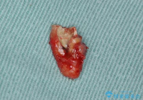 骨の造成を伴うインプラント治療の治療前