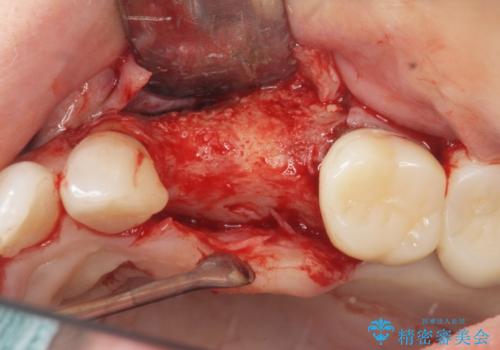骨の造成を伴うインプラント治療の治療中