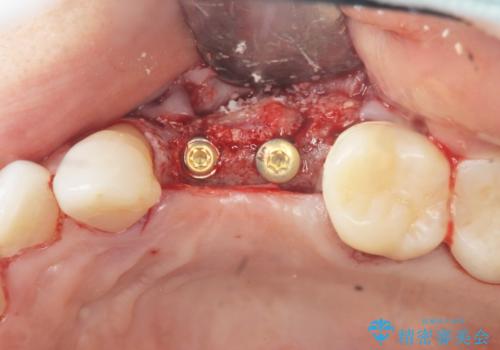 骨の造成を伴うインプラント治療の治療中
