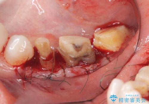 歯ぐきの腫れを改善する歯周外科手術を伴うセラミック治療の治療前