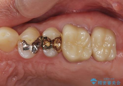臼歯部インプラント・再補綴の治療後