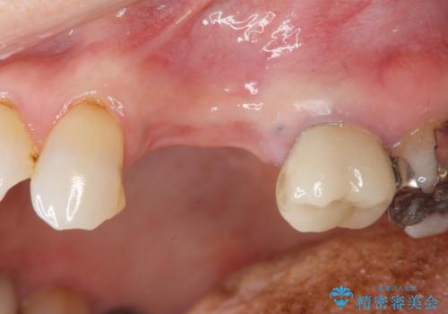 骨の造成を伴うインプラント治療の治療前