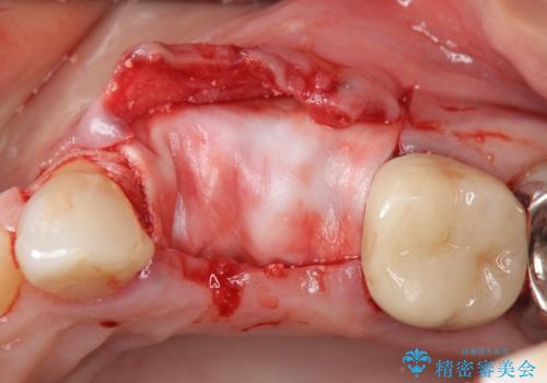 骨の造成を伴うインプラント治療の治療前