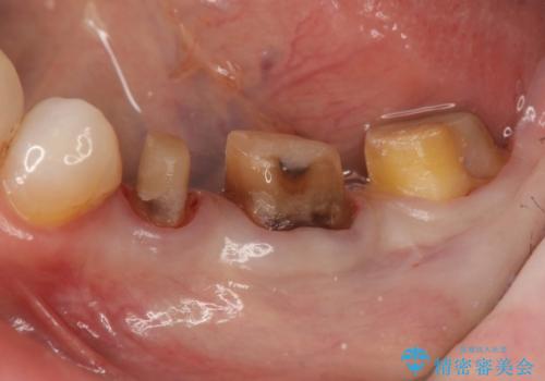 歯ぐきの腫れを改善する歯周外科手術を伴うセラミック治療の治療中