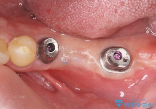 臼歯部インプラント・再補綴の治療中