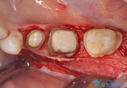 歯ぐきの腫れを改善する歯周外科手術を伴うセラミック治療の治療前
