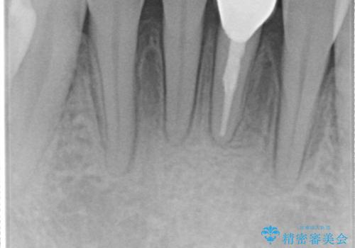 下顎前歯のセラミッククラウンの治療後