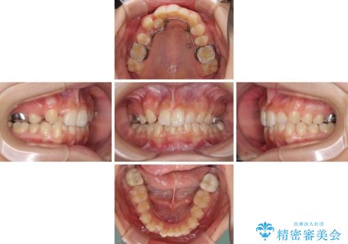 気になる八重歯を改善 補助装置併用のインビザライン治療の治療中