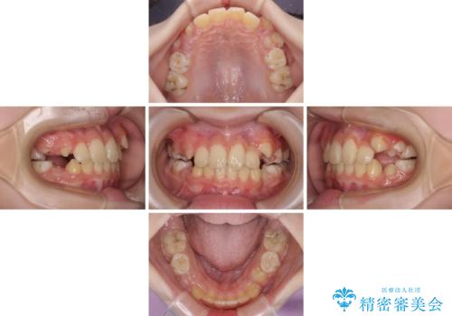 過剰歯を抜歯して前歯を排列 インビザライン・ファーストによる小学生のⅠ期治療の治療中