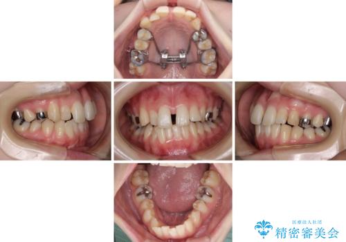 短期間での治療 急速拡大装置を併用したワイヤー装置による矯正治療の治療中