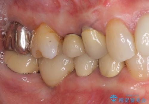 臼歯部メタルフリー再補綴の症例 治療前