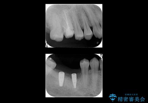 虫歯を放置 しっかり治療したい。 抜歯してインプラント治療の治療中