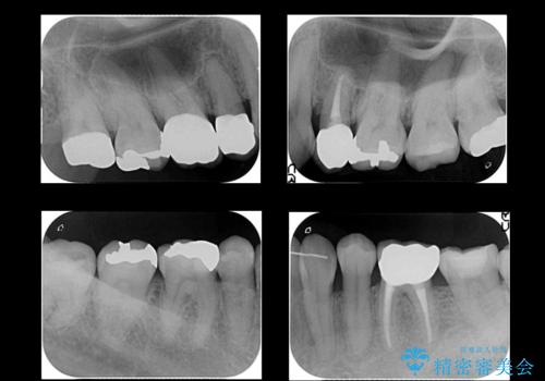 全体的な虫歯治療 の治療後