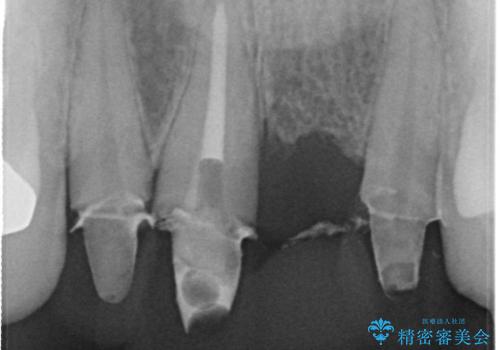 3年間仮歯 前歯セラミックブリッジの治療後