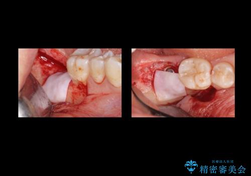 奥歯の歯ぐきからウミが出る 抜歯してインプラントへの治療中