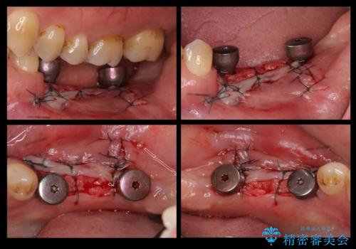 奥歯のインプラント 大人になって残っていた乳歯がダメになったの治療中