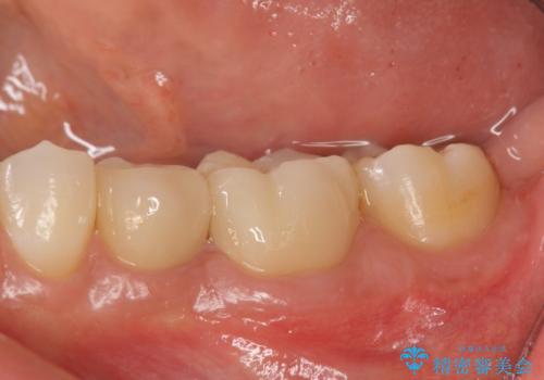 検診で判明した虫歯の再発の治療後