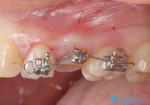放置された虫歯　小矯正+歯周外科による保存処置