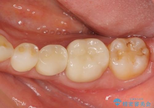 検診で判明した虫歯の再発の症例 治療後