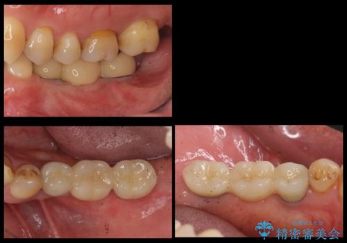 奥歯のインプラント　大人になって残っていた乳歯がダメになったの症例 治療後