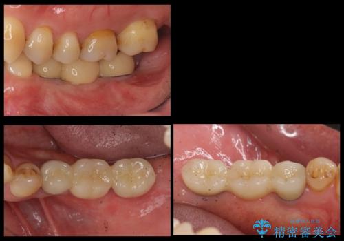 奥歯のインプラント　大人になって残っていた乳歯がダメになったの治療後