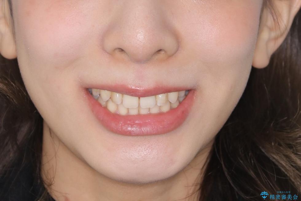 動きづらい前歯のねじれもマウスピース(インビザライン)で改善の治療後(顔貌)