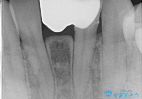 【接着ブリッジ】なるべく歯を削りたくない人への治療後