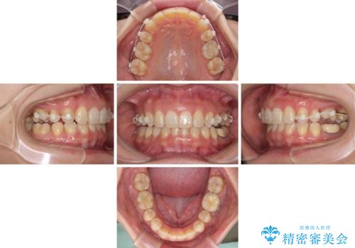 下顎2前歯の欠損 インビザラインによる抜歯矯正の治療中