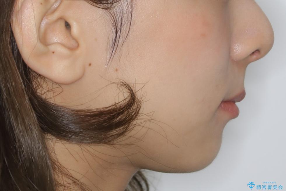 動きづらい前歯のねじれもマウスピース(インビザライン)で改善の治療後(顔貌)