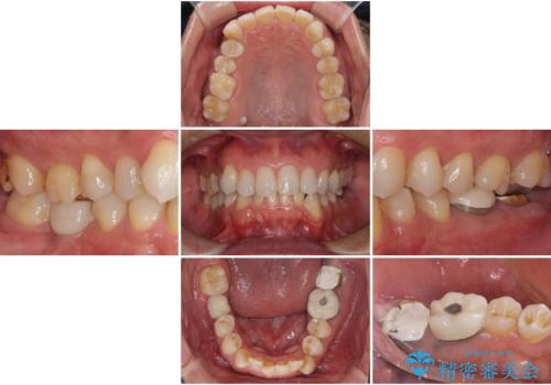 抜歯が必要な奥歯　ストローマン・インプラント補綴治療の治療前