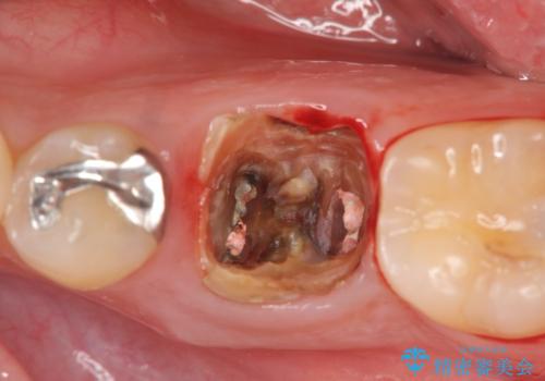 銀歯下の虫歯再発 インプラントによる機能回復の治療前