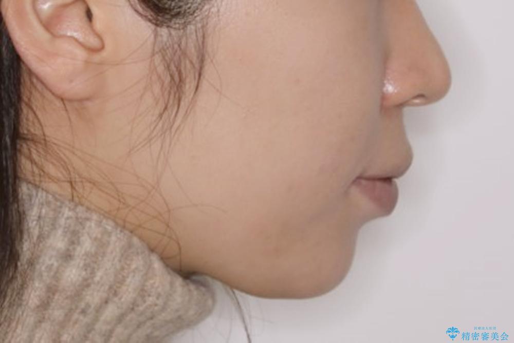 部分矯正とインビザラインを組み合わせて短期間での矯正治療の治療後(顔貌)