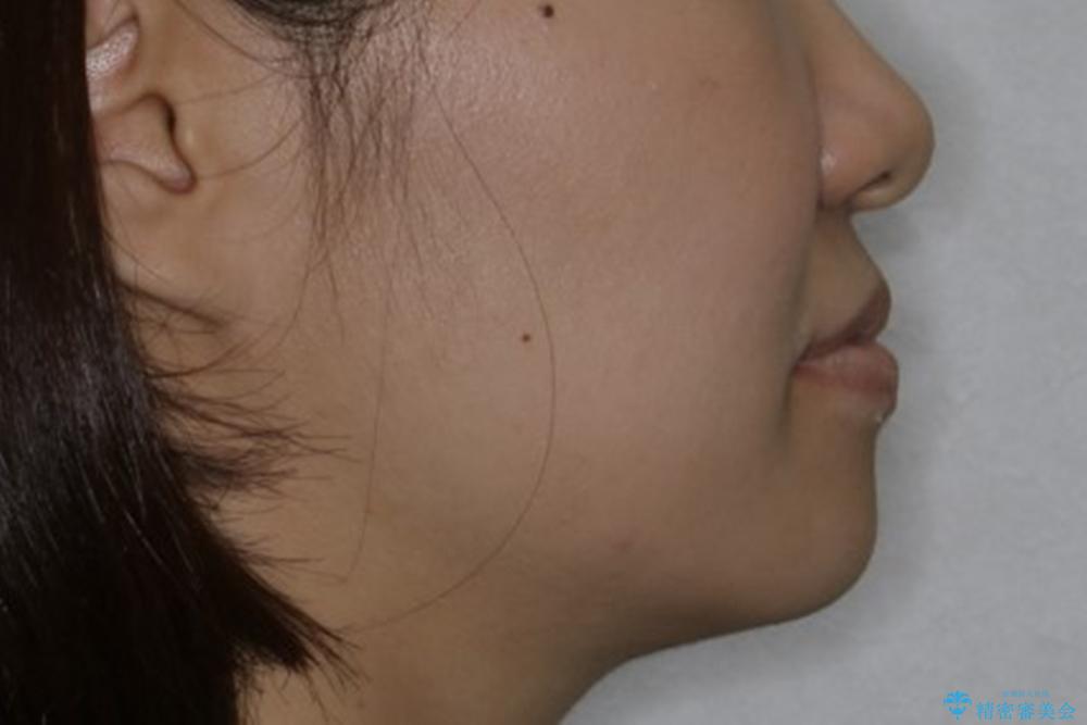 インビザラインで前歯の中心をお顔の中心に合わせるの治療前(顔貌)