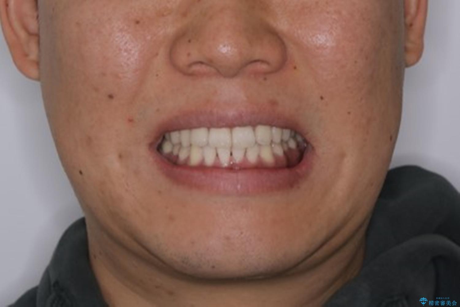 光加速矯正装置(オルソパルス)を用いた短期間での矯正治療の治療後(顔貌)