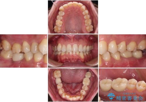 抜歯が必要な奥歯　ストローマン・インプラント補綴治療の治療後